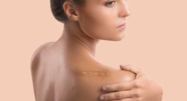 keloid-scars keloid-scars
